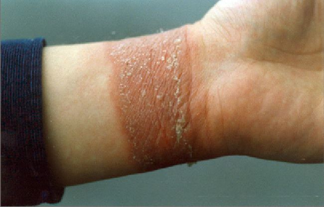 Wrist allergy caused by a bracelet Wrist allergy caused by a bracelet